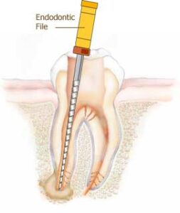 endodoncija3