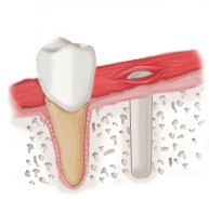 Ilustracija otvora u vilicnoj kosti za implant