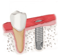 Ilustracija implanta u vilicnoj kosti