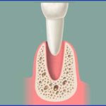 U kojim situacijama ugraditi zubne implantate 3