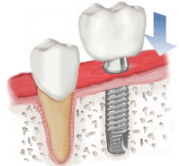 Ilustracija krune koja se postavlja na zubni implant